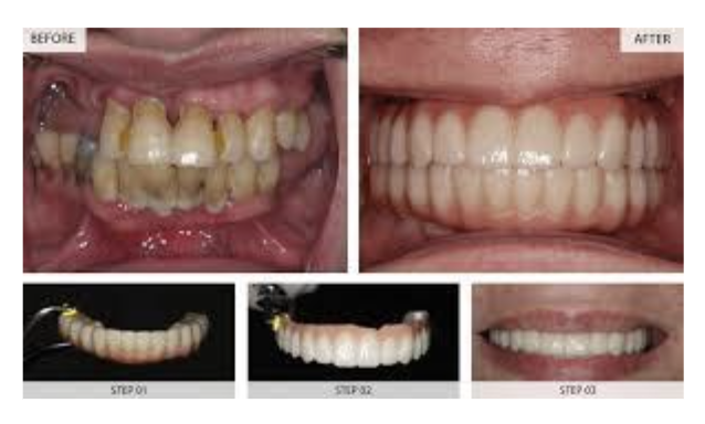 Cost Of Dental Implant